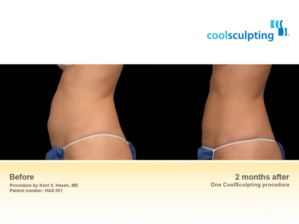 your chicago area coolsculpting medspa your chicago area coolsculpting medspa