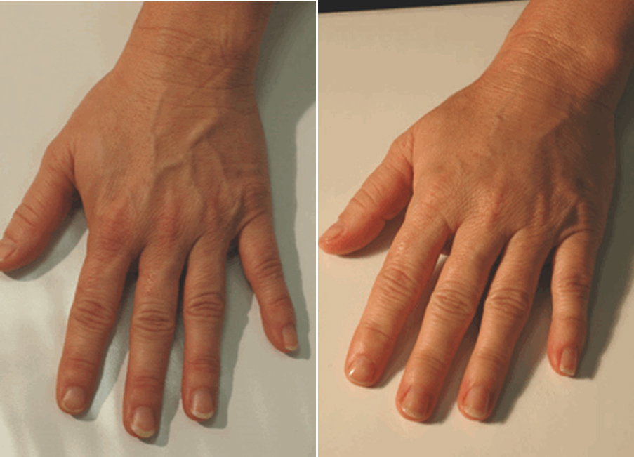 Hand Rejuvenation Pasadena La Canada Los Angeles LA CA