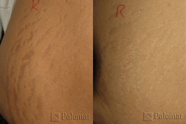 Stretch Marks Pasadena La Canada Flintridge Los Angeles LA CA