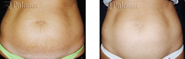 Stretch Marks Pasadena La Canada Flintridge Los Angeles LA CA