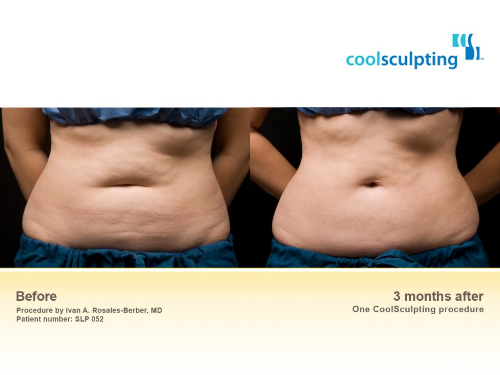 CoolSculpting Pasadena La Canada Flintridge Los Angeles LA CA