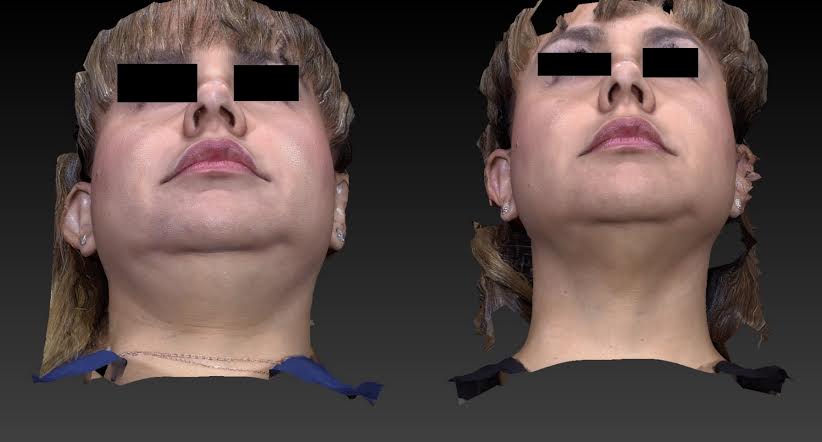 Kybella for a Chiseled Jawline, Utah Facial Plastics